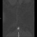 Chance fracture (Radiopaedia 36521-38081 Coronal bone window 71).jpg