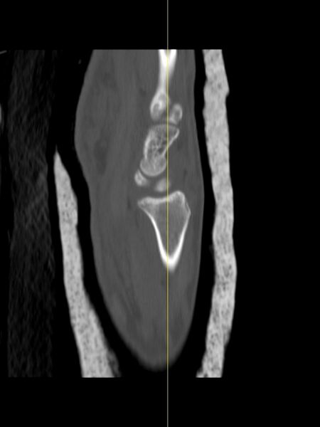 File:Chauffeur's (Hutchinson) fracture (Radiopaedia 58043-65079 Sagittal bone window 10).jpg