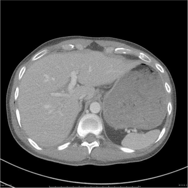 File:Chest and abdomen multi-trauma (Radiopaedia 26294-26426 bone window 20).jpg