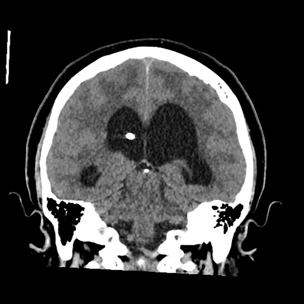 File:Chiasmatic-hypothalamic juvenile pilocytic astrocytoma (Radiopaedia 78533-91237 Coronal non-contrast 43).jpg