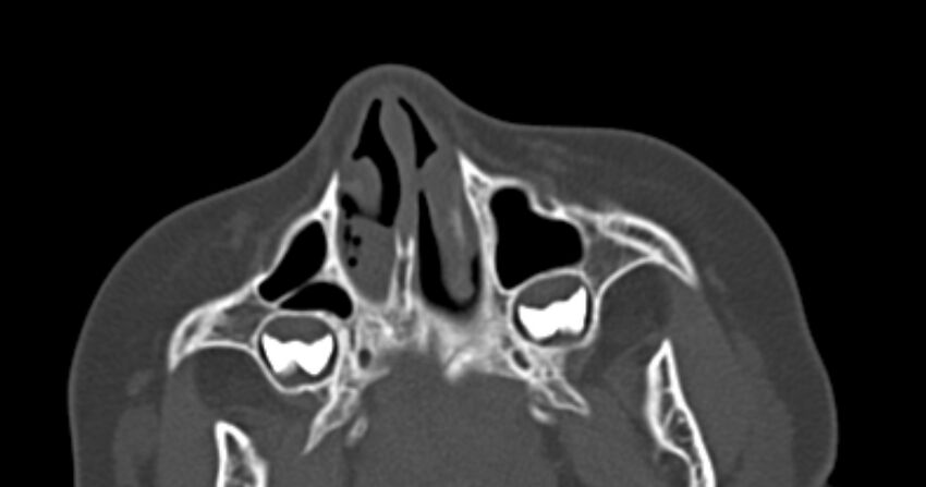 Choanal atresia (Radiopaedia 51295-56972 Axial bone window 12).jpg