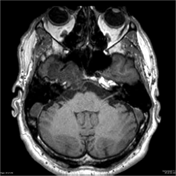 File:Chondrosarcoma of skull base- grade II (Radiopaedia 40948-43654 Axial T1 28).jpg