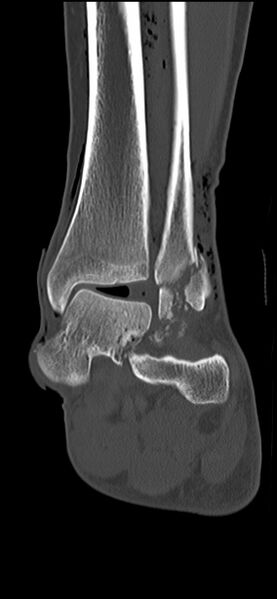 File:Chopart fracture (Radiopaedia 35347-36851 Coronal bone window 33).jpg