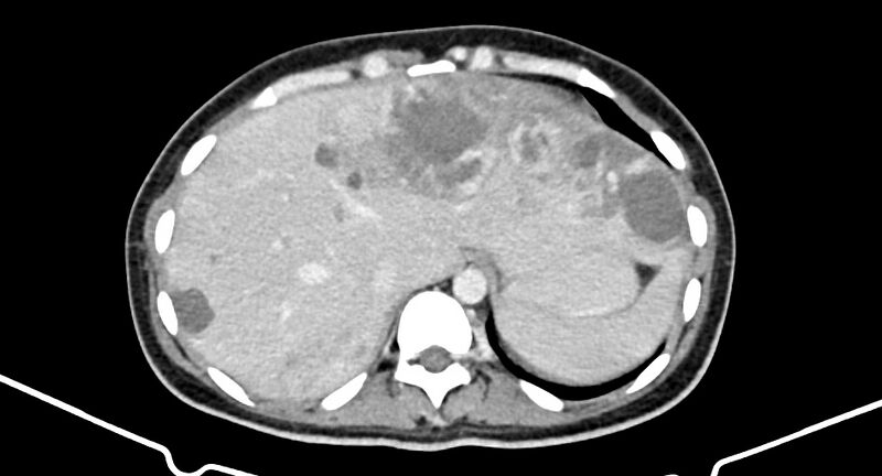File:Choriocarcinoma liver metastases (Radiopaedia 74768-85766 A 42).jpg