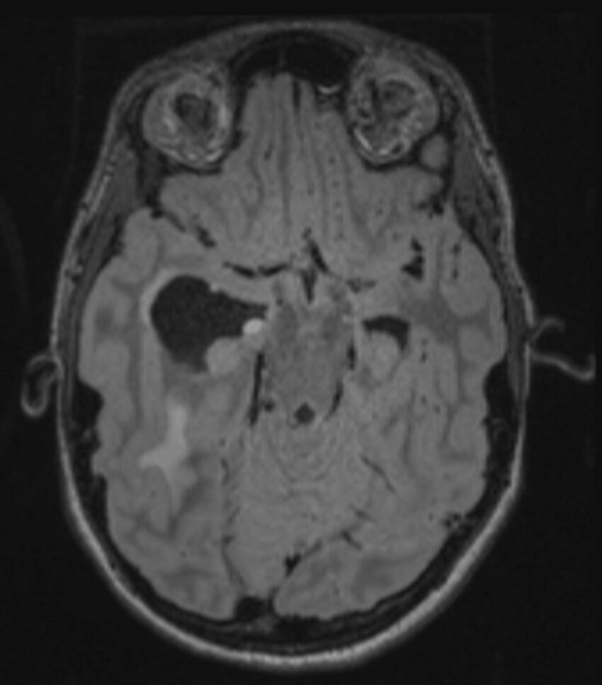 Choroid plexus carcinoma (Radiopaedia 91013-108553 Axial FLAIR C+ 113).jpg