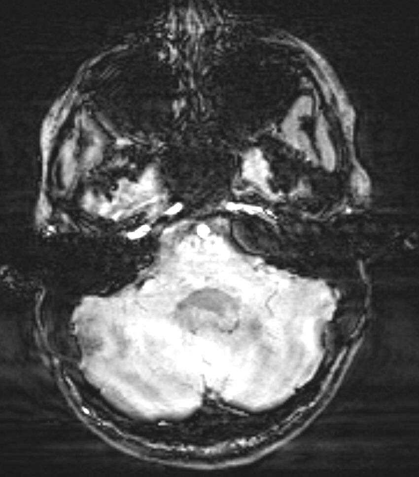Choroid plexus carcinoma (Radiopaedia 91013-108553 Axial SWI 22).jpg