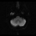 Choroid plexus xanthogranuloma (Radiopaedia 17650-17386 DWI 19).jpg