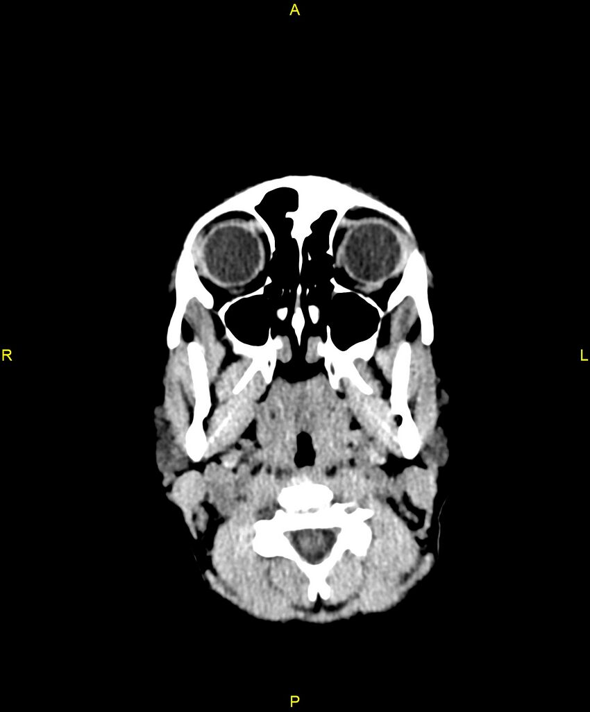 Choroidal fissure cyst (Radiopaedia 89481-106465 Axial non-contrast 5).jpg