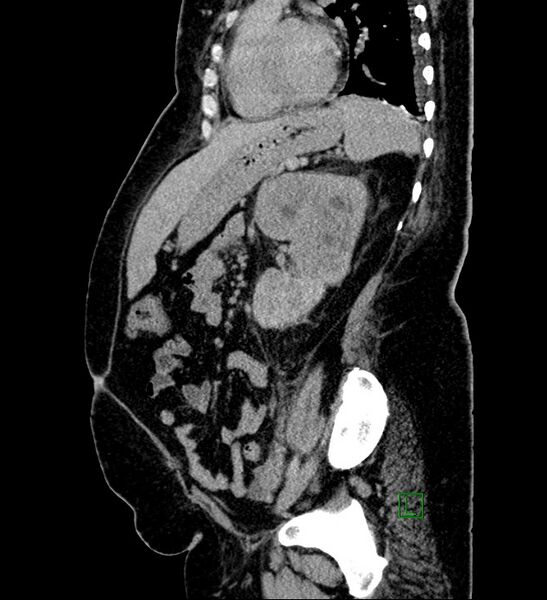 File:Chromophobe renal cell carcinoma (Radiopaedia 84239-99519 G 43).jpg