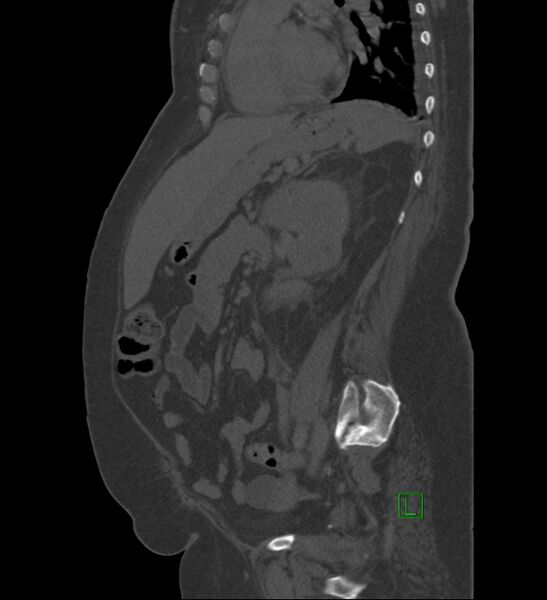 File:Chromophobe renal cell carcinoma (Radiopaedia 84239-99519 Sagittal bone window 40).jpg