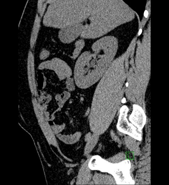 File:Chromophobe renal cell carcinoma (Radiopaedia 84286-99573 C 122).jpg