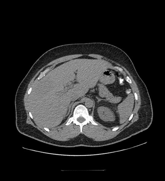 File:Chromophobe renal cell carcinoma (Radiopaedia 84337-99644 Axial non-contrast 24).jpg