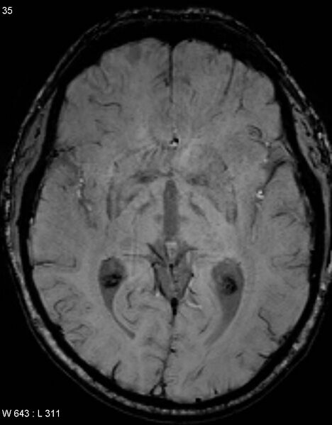 File:Chronic lymphocytic inflammation with pontine perivascular enhancement responsive to steroids (CLIPPERS) (Radiopaedia 37520-39374 Axial SWI 34).jpg