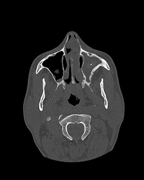 File:Chronic maxillary sinusitis caused by a foreign body (Radiopaedia 58521-65676 Axial bone window 102).jpg