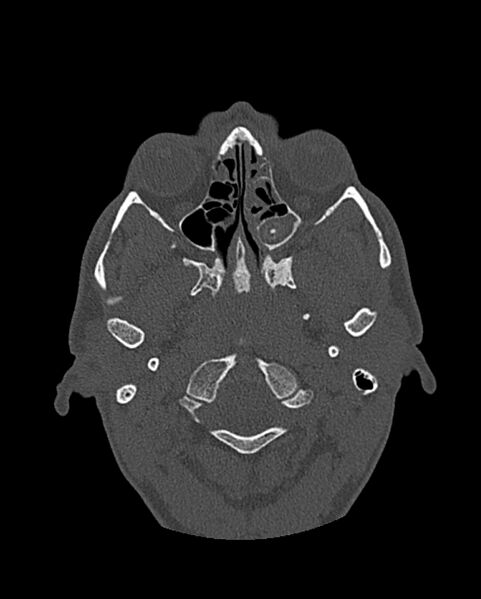 File:Chronic maxillary sinusitis caused by a foreign body (Radiopaedia 58521-65676 Axial bone window 177).jpg