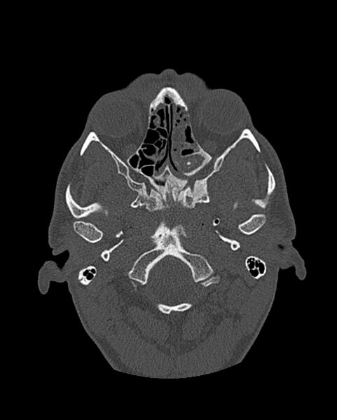 File:Chronic maxillary sinusitis caused by a foreign body (Radiopaedia 58521-65676 Axial bone window 186).jpg