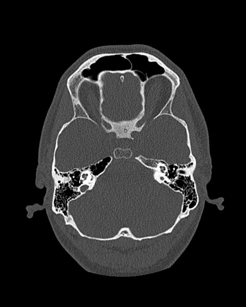 File:Chronic maxillary sinusitis caused by a foreign body (Radiopaedia 58521-65676 Axial bone window 249).jpg