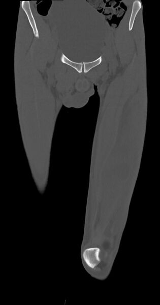 File:Chronic osteomyelitis (with sequestrum) (Radiopaedia 74813-85822 Coronal non-contrast 12).jpg