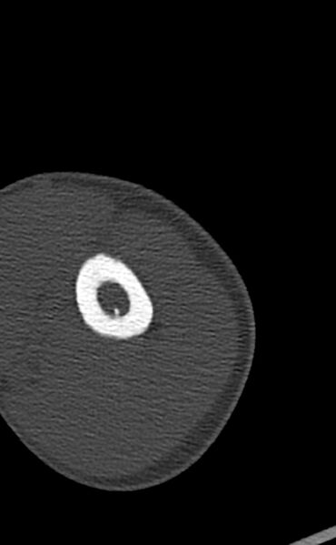 File:Chronic osteomyelitis of the distal humerus (Radiopaedia 78351-90971 Axial bone window 27).jpg