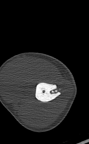File:Chronic osteomyelitis of the distal humerus (Radiopaedia 78351-90971 Axial bone window 54).jpg