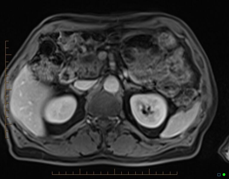 File:Chronic pancreatitis (Radiopaedia 17014-16716 Axial T1 C+ fat sat 31).jpg