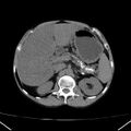 Chronic pancreatitis (Radiopaedia 23132-23172 Axial non-contrast 24).jpg