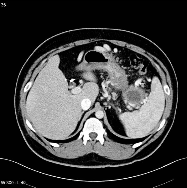 File:Chronic pancreatitis and pseudocysts (Radiopaedia 6724-7935 B 2).jpg