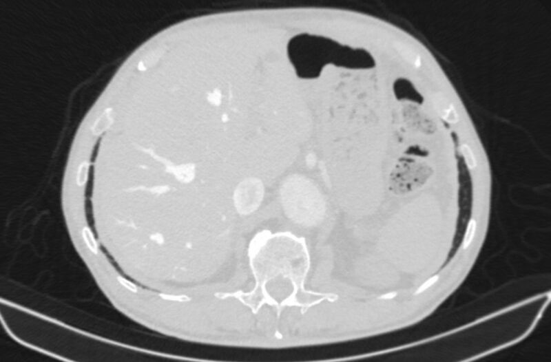 File:Chronic pulmonary embolism (Radiopaedia 91241-108843 Axial lung window 91).jpg