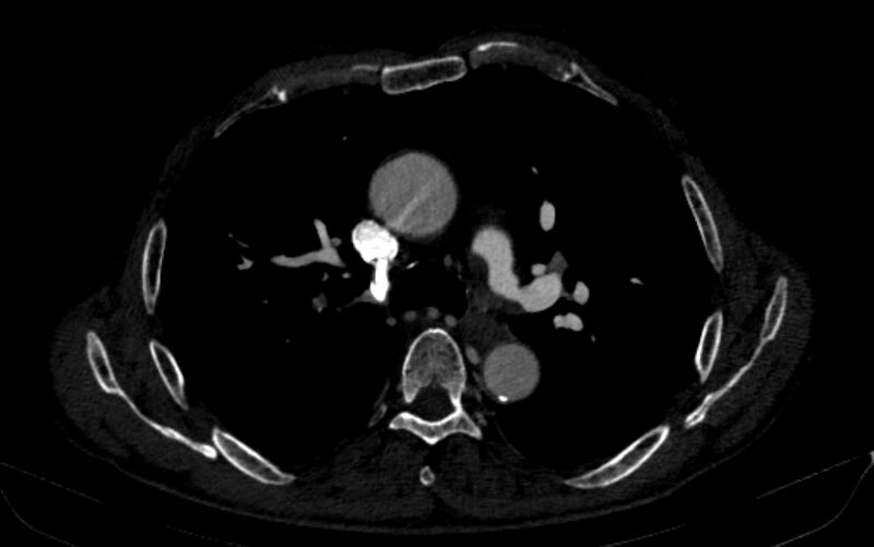 File:Chronic pulmonary embolism (Radiopaedia 91241-108843 B 73).jpg