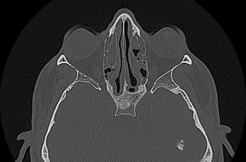 File:Chronic rhinosinusitis (Radiopaedia 65079-74075 Axial bone window 50).jpg