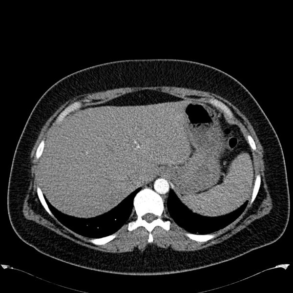 File:Chronic thromboembolic pulmonary hypertension (CTEPH) (Radiopaedia 74597-85531 Axial C+ CTPA 48).jpg