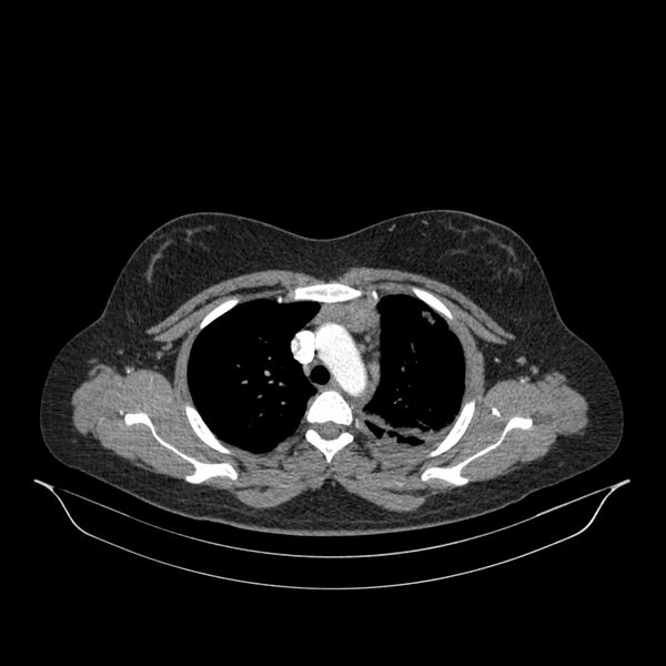 File:Chronic thromboembolic pulmonary hypertension (CTEPH) (Radiopaedia 74597-85532 Axial C+ CTPA 117).jpg