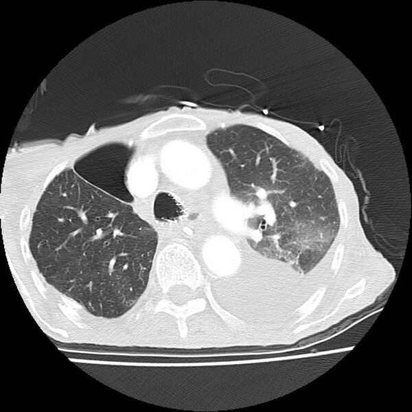 File:Clagett thoracotomy with bronchopleural fistula (Radiopaedia 29192-29587 Axial lung window 17).jpg