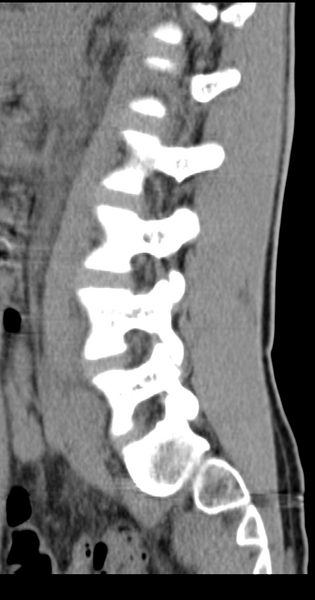 File:Clear cell meningoma - lumbar spine (Radiopaedia 60116-67691 A 15).png