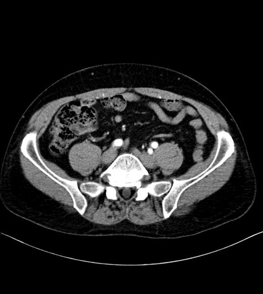 File:Clear cell renal cell carcinoma (Radiopaedia 85006-100539 B 63).jpg
