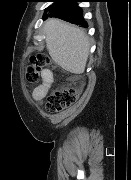File:Closed loop obstruction - internal hernia into nephrectomy bed (Radiopaedia 59867-67320 C 97).jpg