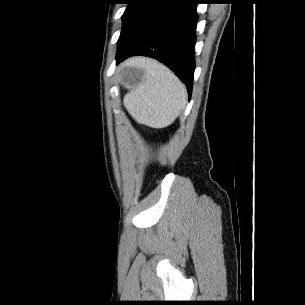 File:Co-existing acute appendicitis and epiploic appendagitis (Radiopaedia 61789-69911 B 84).jpg