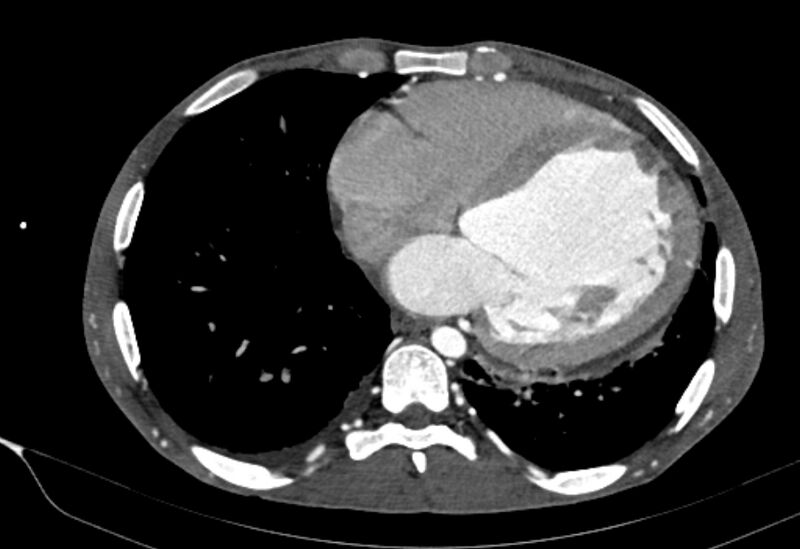 File:Coarctation of aorta with aortic valve stenosis (Radiopaedia 70463-80574 A 150).jpg
