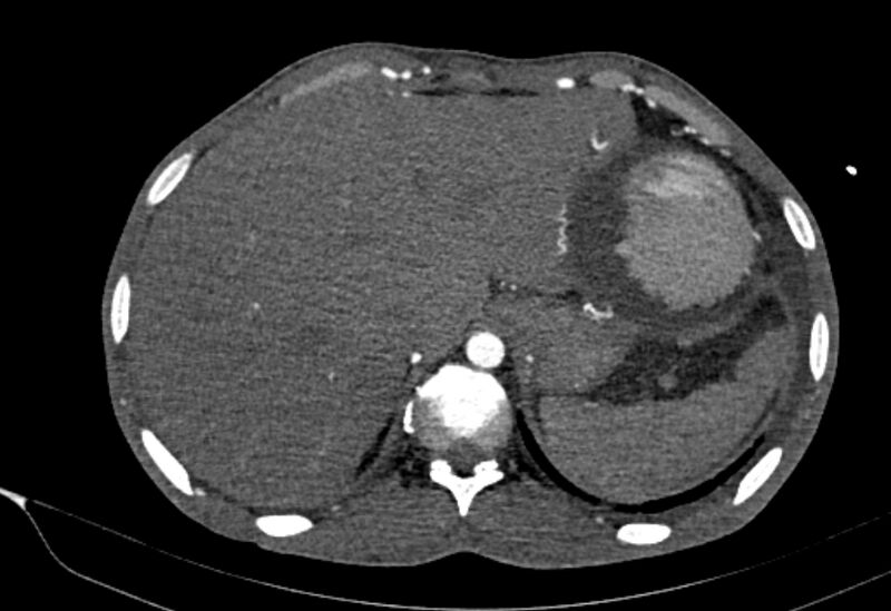 File:Coarctation of aorta with aortic valve stenosis (Radiopaedia 70463-80574 A 216).jpg