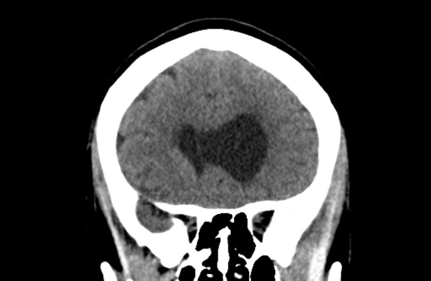 Colloid cyst (Radiopaedia 53180-59146 Coronal non-contrast 22).jpg