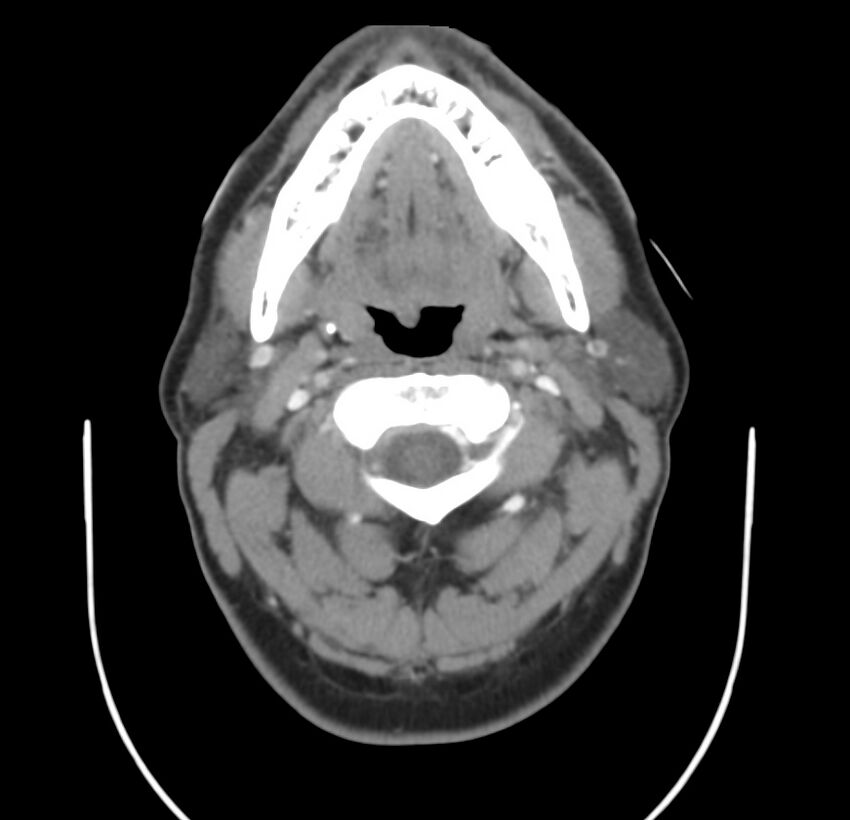 Colloid cyst of thyroid (Radiopaedia 22897-22923 Axial C+ delayed 27).jpg