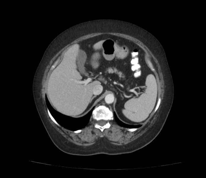 File:Colonic diverticulosis (Radiopaedia 22934-22957 A 18).jpg