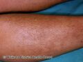 Lichen amyloidosis (DermNet NZ scaly-w-lichen-amyloid).jpg