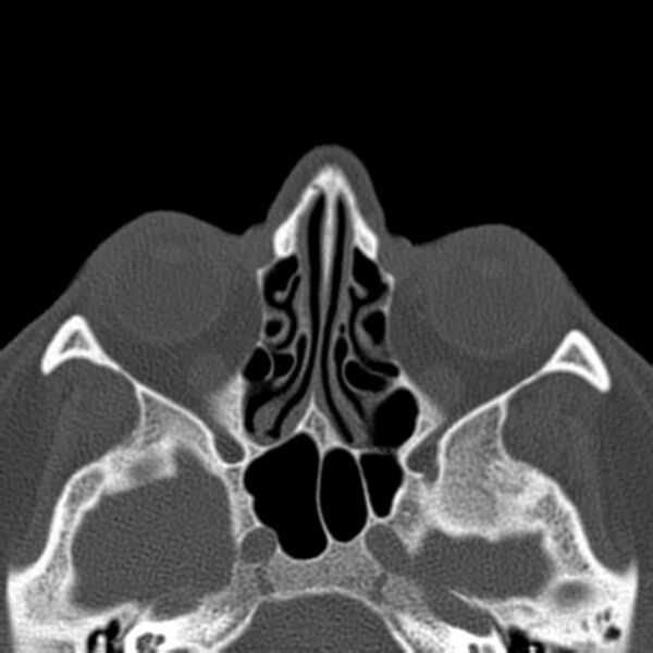 File:Nasolabial cyst (Radiopaedia 33987-35205 Axial bone window 27).jpg