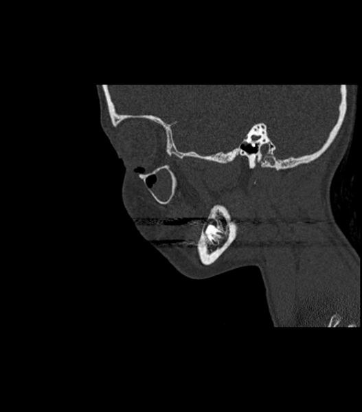 File:Nasoorbitoethmoid fracture (Radiopaedia 90044-107205 Sagittal bone window 106).jpg