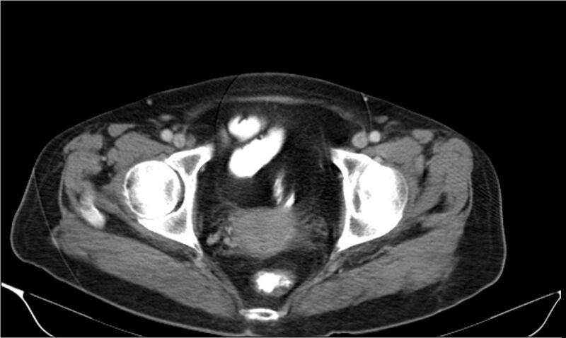 File:Necrotizing pancreatitis (Radiopaedia 20595-20495 A 43).jpg
