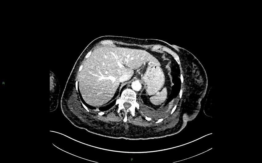 Neo-terminal ileal stricture (Crohn disease) (Radiopaedia 33790-34948 A 71).jpg