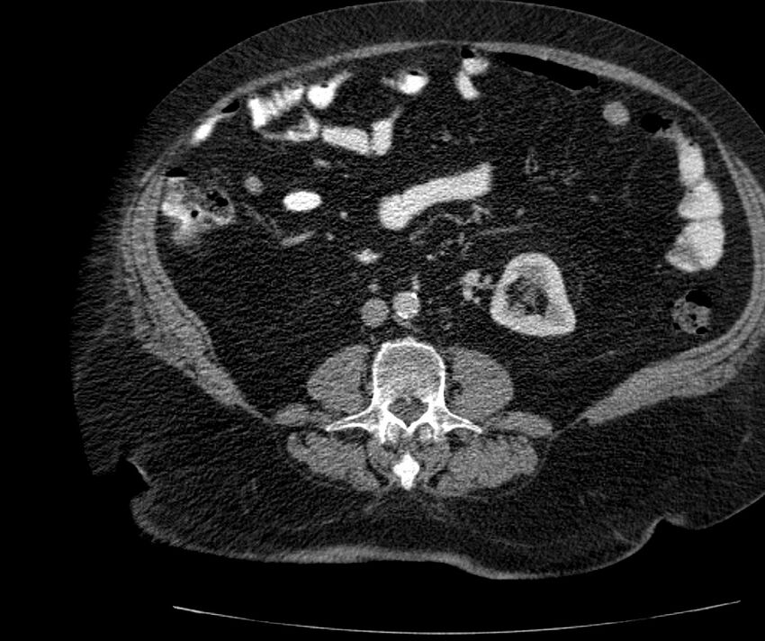 Nephroptosis with inguinal hernia containing perirenal fat (Radiopaedia 56632-63391 C 188).jpg