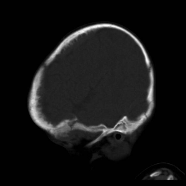 File:Neuroblastoma with skull metastases (Radiopaedia 30326-30958 Sagittal bone window 35).jpg