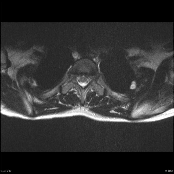 File:Neurofibromatosis type 1 (Radiopaedia 22541-22565 Axial T2 2).jpg
